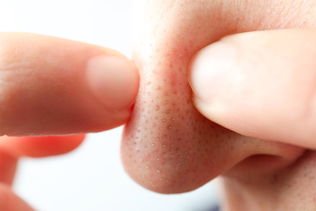 Bouton d'acné : percer ou pas ? — Neigeline, experte Acné